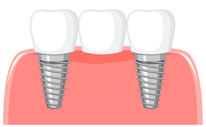 Dama Dent Clinic Dr. Dina Abdallah Dental Bridge
