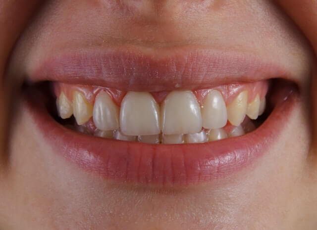 Dama Dent Clinic Dr. Dina Abdallah teeth Whitening