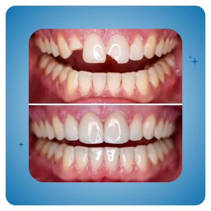 Dama Dent Clinic Dr. Dina Abdallah Case 28