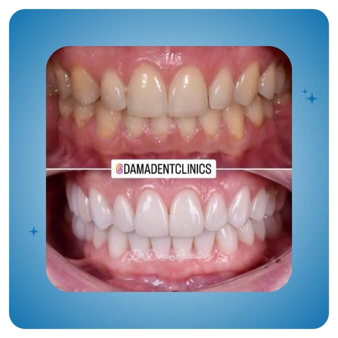 Dama Dent Clinic Dr. Dina Abdallah Case 26
