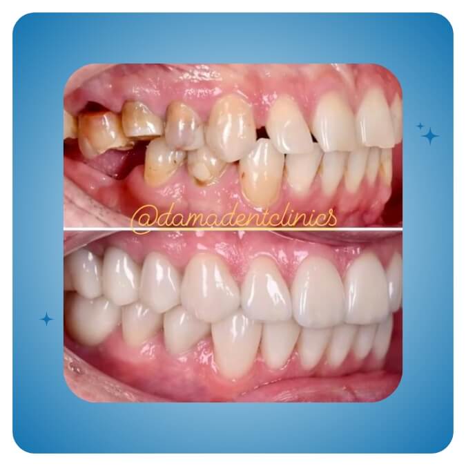 Dama Dent Clinic Dr. Dina Abdallah Case 23