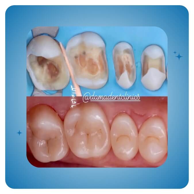 Dama Dent Clinic Dr. Dina Abdallah Case 24