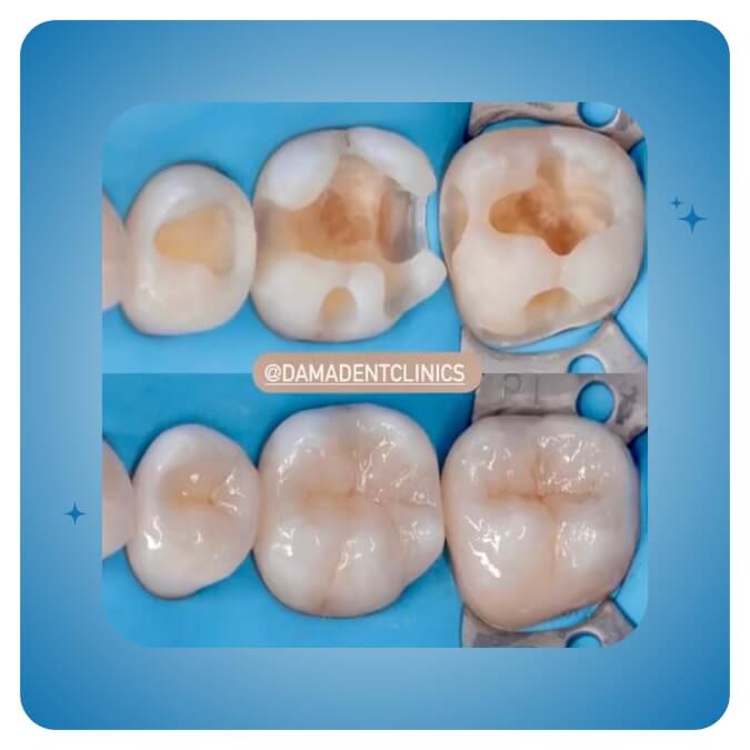 Dama Dent Clinic Dr. Dina Abdallah Case 25