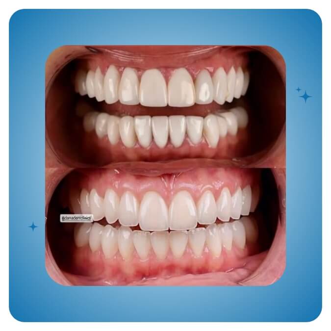 Dama Dent Clinic Dr. Dina Abdallah Case 22
