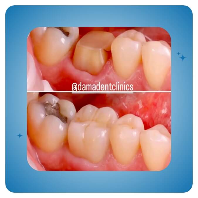 Dama Dent Clinic Dr. Dina Abdallah Case 21