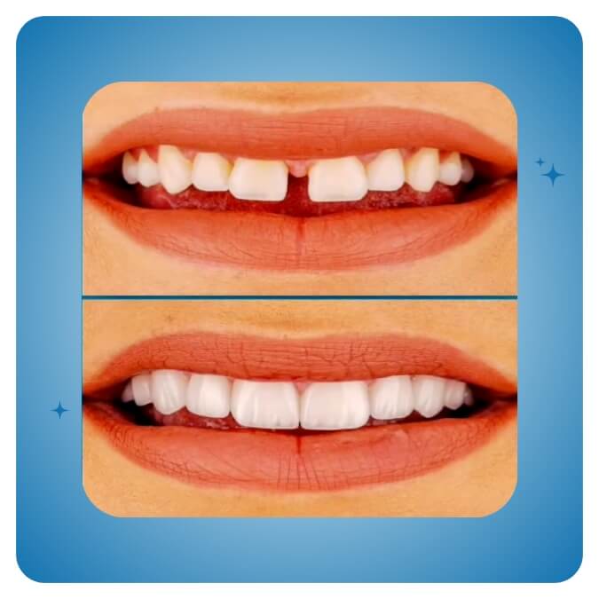 Dama Dent Clinic Dr. Dina Abdallah Case 19
