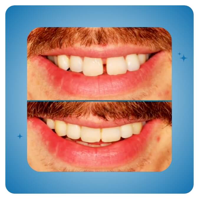 Dama Dent Clinic Dr. Dina Abdallah Case 16