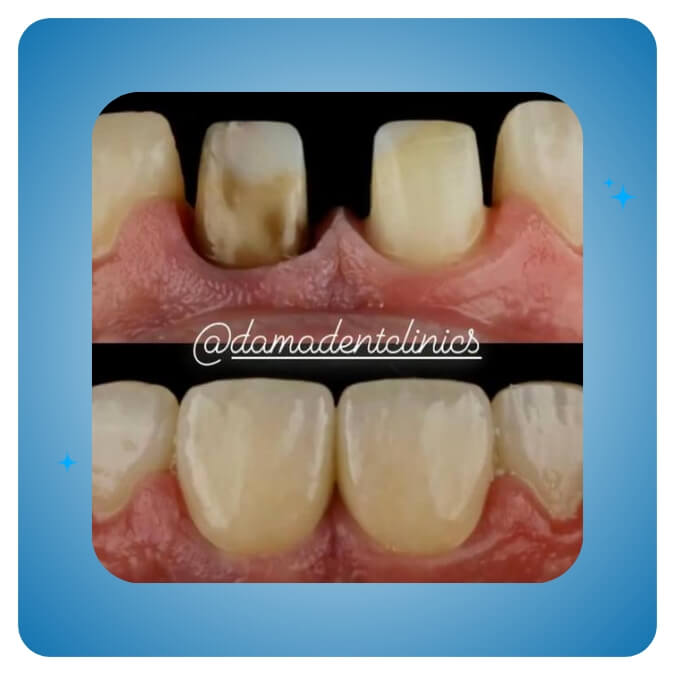 Dama Dent Clinic Dr. Dina Abdallah Case 17