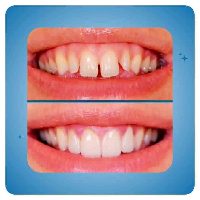 Dama Dent Clinic Dr. Dina Abdallah Case 18