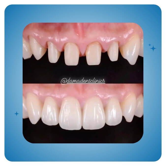 Dama Dent Clinic Dr. Dina Abdallah Case 14