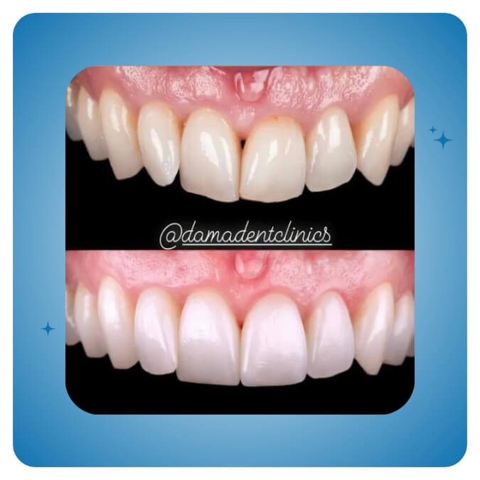 Dama Dent Clinic Dr. Dina Abdallah Case 15