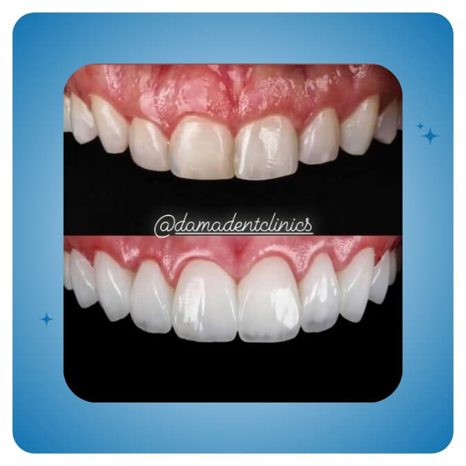 Dama Dent Clinic Dr. Dina Abdallah Case 10