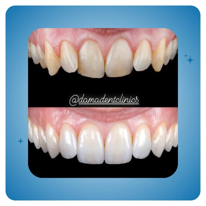 Dama Dent Clinic Dr. Dina Abdallah Case 11