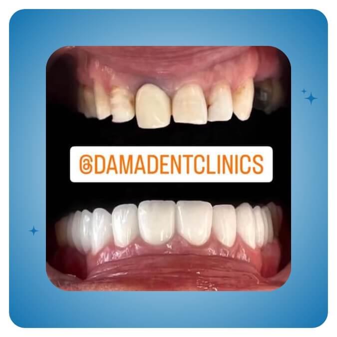 Dama Dent Clinic Dr. Dina Abdallah Case 8