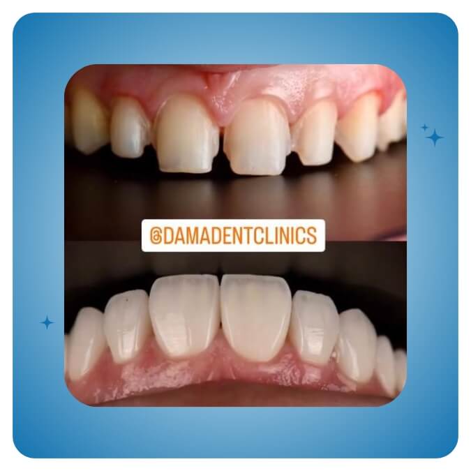 Dama Dent Clinic Dr. Dina Abdallah Case 7