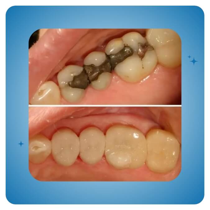 Dama Dent Clinic Dr. Dina Abdallah Case 6