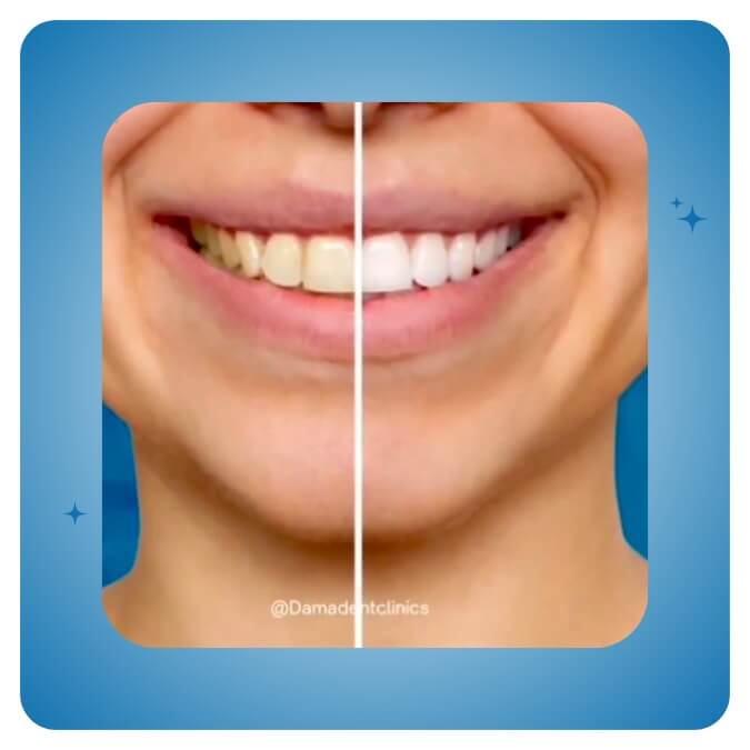 Dama Dent Clinic Dr. Dina Abdallah Case 5