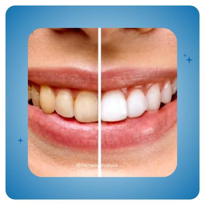 Dama Dent Clinic Dr. Dina Abdallah Case 4