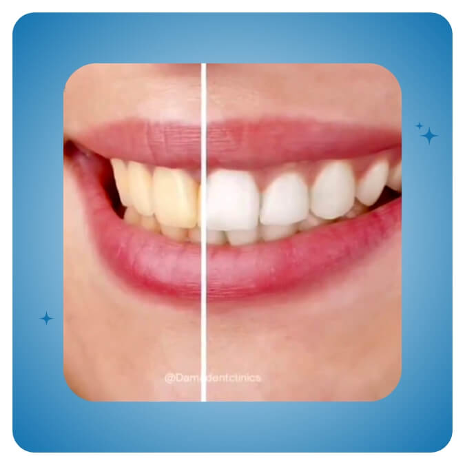 Dama Dent Clinic Dr. Dina Abdallah Case 2